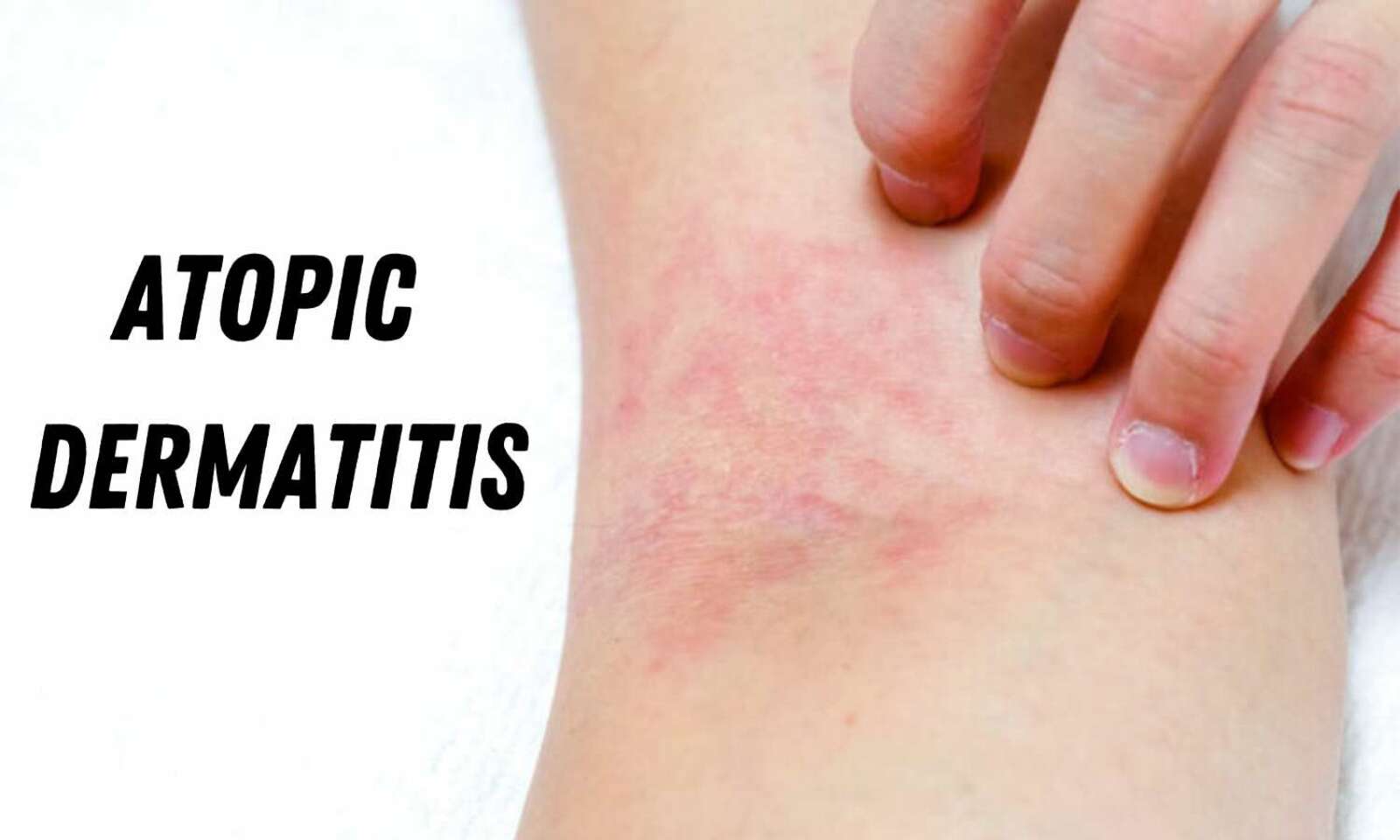 Early Signs Of Atopic Dermatitis Recognize To Provide Best Care 1749