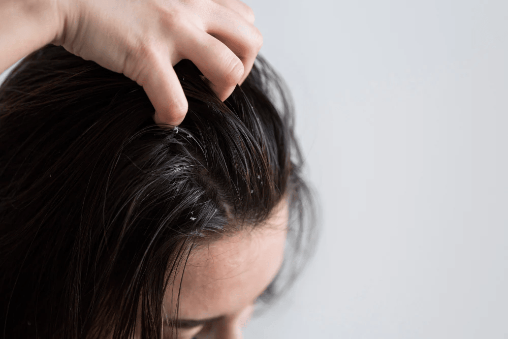 How Diet and Lifestyle Impact the Oil Production of Your Scalp?