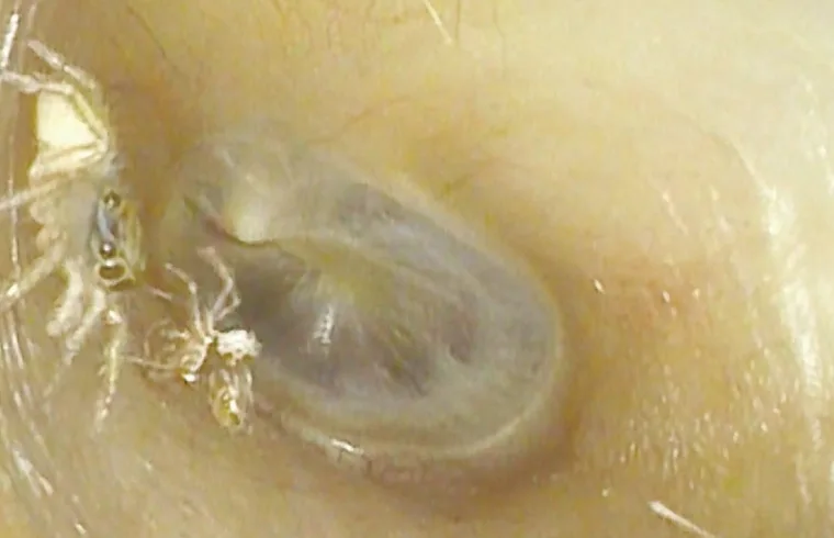 The Eight-Legged Ear Invader: Woman's Terrifying Spider Encounter Sends Shivers Down Spines