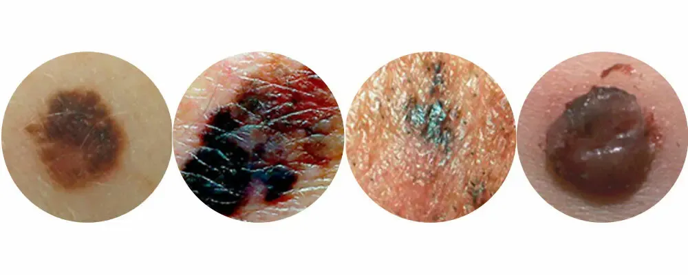 Melanoma In 2024 Advances And Awareness In The Fight Against Skin Cancer   XmWXL 1708596398775.webp